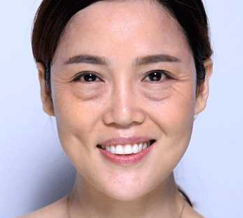 去眼袋手术