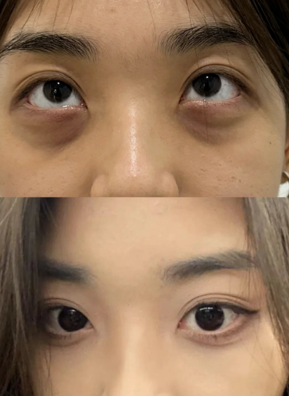 去眼袋手术