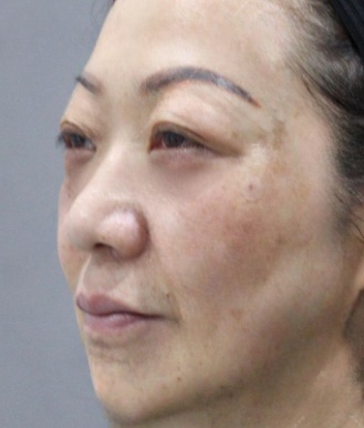 去眼袋手术