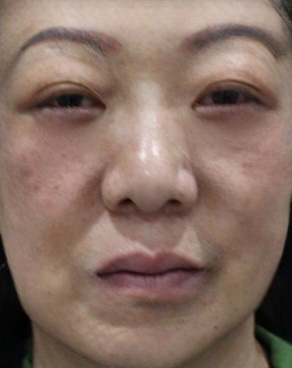 去眼袋手术