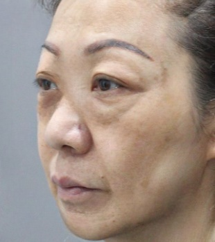 去眼袋手术