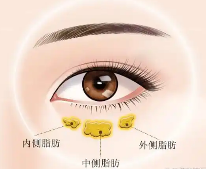 去眼袋手术