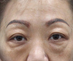 去眼袋手术