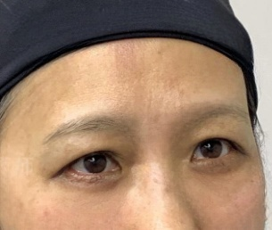 去眼袋手术