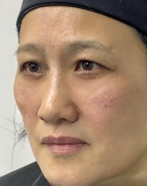去眼袋手术