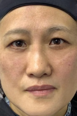 去眼袋手术
