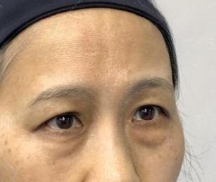 去眼袋手术