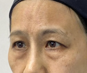 去眼袋手术