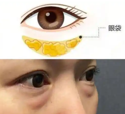 去眼袋手术
