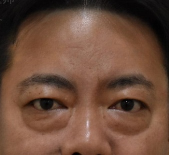 去眼袋手术