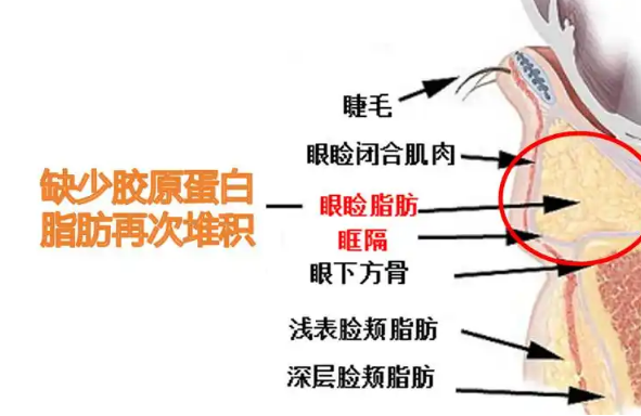 去眼袋手术
