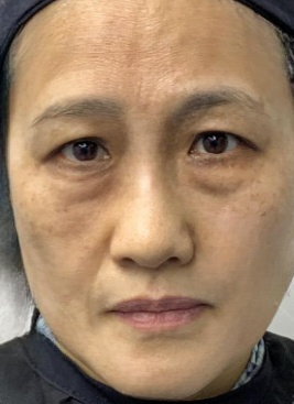 去眼袋手术