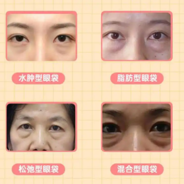 去眼袋手术
