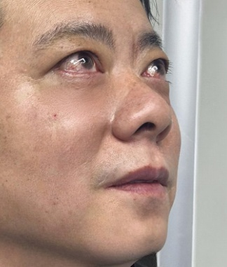 去眼袋手术