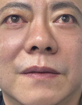 去眼袋手术