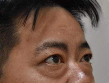 去眼袋手术