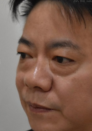 去眼袋手术