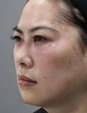 去眼袋手术
