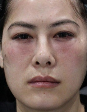 去眼袋手术