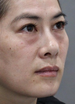 去眼袋手术