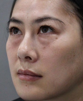 去眼袋手术