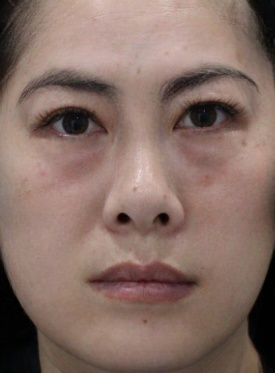 去眼袋手术