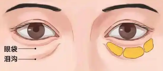 去眼袋手术