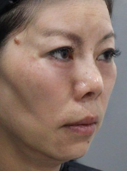 去眼袋手术