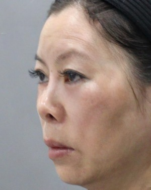 去眼袋手术