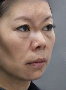 去眼袋手术