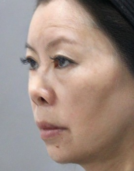 去眼袋手术