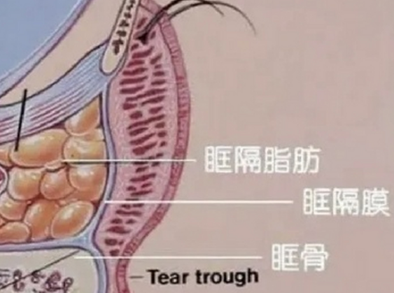 去眼袋手术