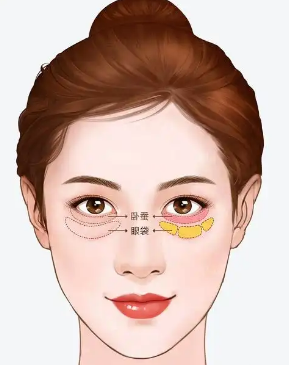 去眼袋手术