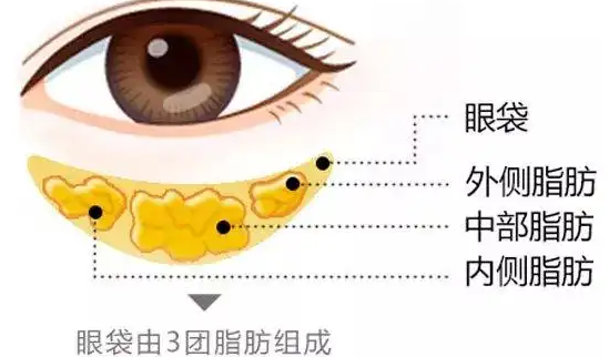 去眼袋手术