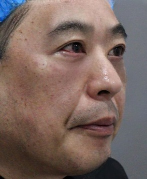去眼袋手术