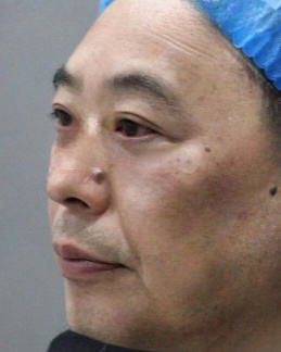 去眼袋手术
