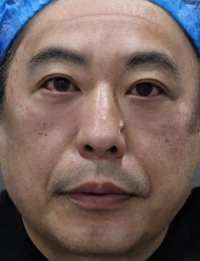 去眼袋手术