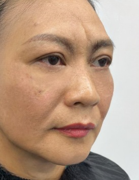 去眼袋手术