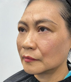 去眼袋手术