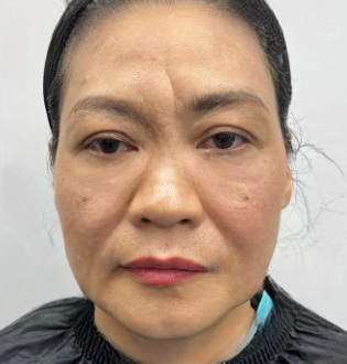 去眼袋手术