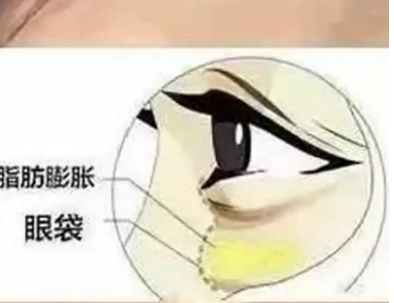 去眼袋手术