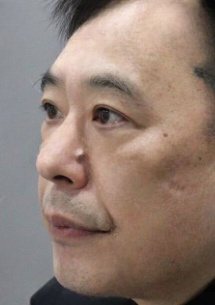 去眼袋手术