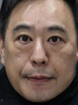 去眼袋手术