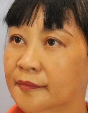 去眼袋手术