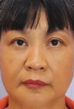 去眼袋手术