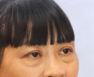 去眼袋手术