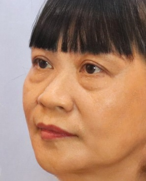 去眼袋手术