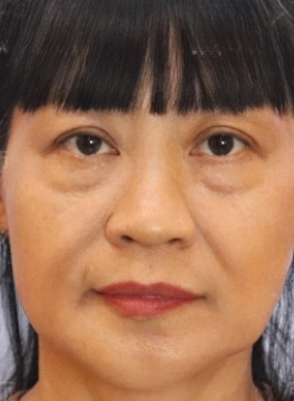 去眼袋手术