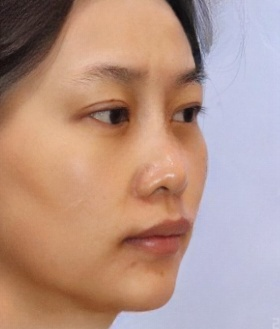 去眼袋手术