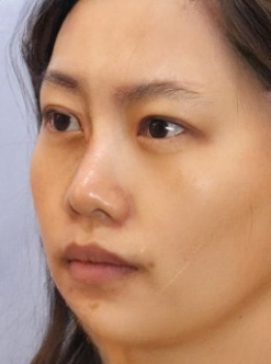 去眼袋手术